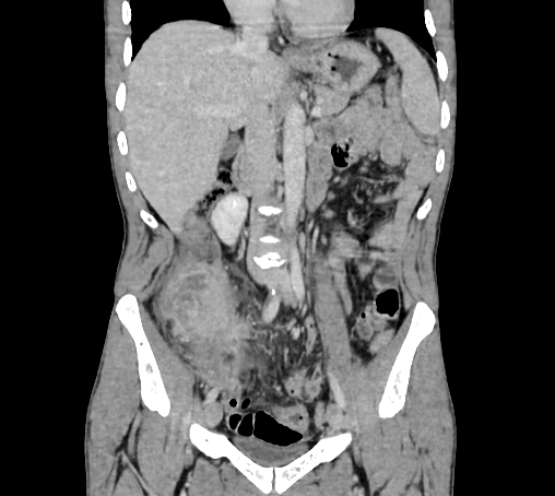 Bronchiectasis in Crohn disease (Radiopaedia 60311-67977 C 36).jpg
