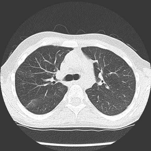 File:Bronchiolotis obliterans (Radiopaedia 73769-84575 Axial lung window 18).jpg