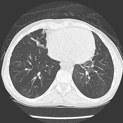 Bronchiolotis obliterans (Radiopaedia 73769-84575 Axial lung window 33).jpg