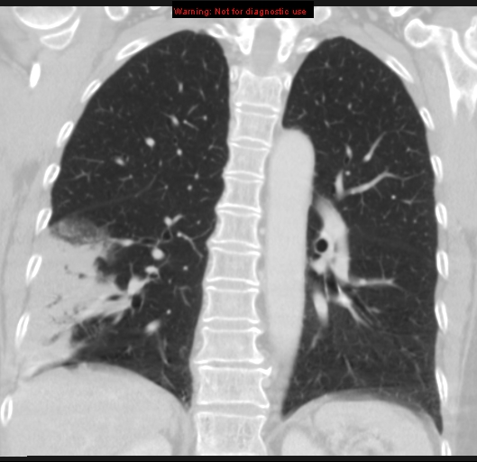 File:Bronchoalveolar carcinoma (BAC) (Radiopaedia 13436-13392 Coronal lung window 38).jpg