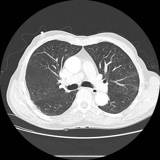 Bronchocele (Radiopaedia 17097-16795 Axial lung window 52).jpg