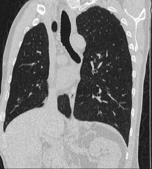 File:Bronchocele (Radiopaedia 60676-68429 Oblique lung window 17).jpg