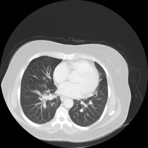 File:Bronchogenic carcinoma (Radiopaedia 73497-84262 Axial lung window 41).jpg