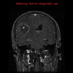 File:Bronchogenic carcinoma brain metastasis (Radiopaedia 9286-9969 Coronal T1 13).jpg