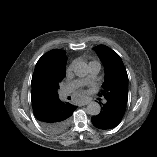 Bronchogenic carcinoma with metastatic lymphadenopathy (Radiopaedia 37671-39569 Axial non-contrast 29).jpg