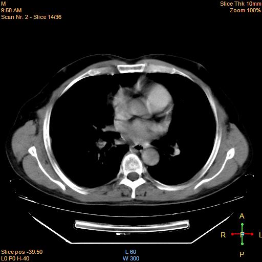 File:Bronchogenic carcinoma with superior vena caval invasion (Radiopaedia 22378-22406 Axial liver window 12).jpg