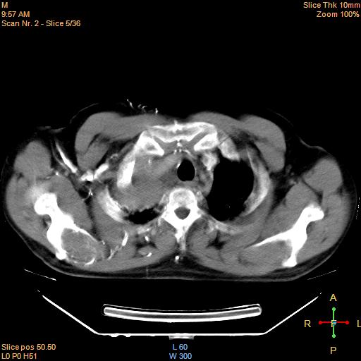 File:Bronchogenic carcinoma with superior vena caval invasion (Radiopaedia 22378-22406 Axial liver window 3).jpg