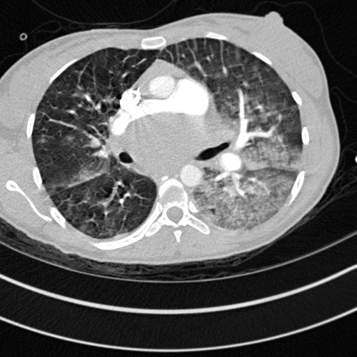 Bronchogenic cyst (Radiopaedia 77801-90071 Axial lung window 28).jpg