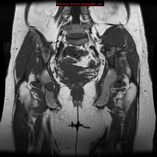 File:Brown tumors (Radiopaedia 9666-10290 Coronal T1 18).jpg
