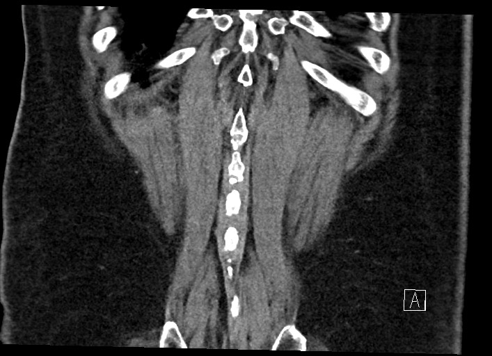 Buried bumper syndrome - gastrostomy tube (Radiopaedia 63843-72577 Coronal Inject 128).jpg