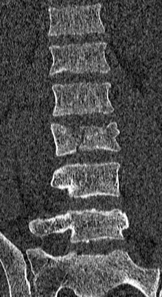 Burst fracture (Radiopaedia 53373-59357 Coronal bone window 35).jpg