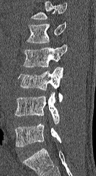 Burst fracture (Radiopaedia 53373-59357 Sagittal bone window 52).jpg