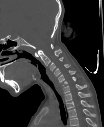 File:Butterfly vertebra (Radiopaedia 77903-90209 Sagittal bone window 43).jpg