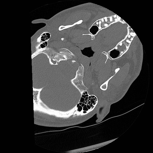 C1-C2 "subluxation" - normal cervical anatomy at maximum head rotation (Radiopaedia 42483-45607 Axial non-contrast 64).jpg