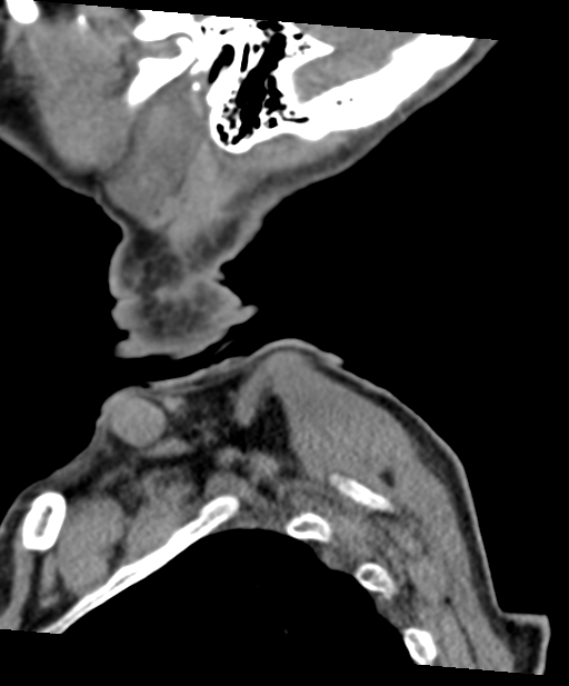 C2 fracture with vertebral artery dissection (Radiopaedia 37378-39199 D 76).png