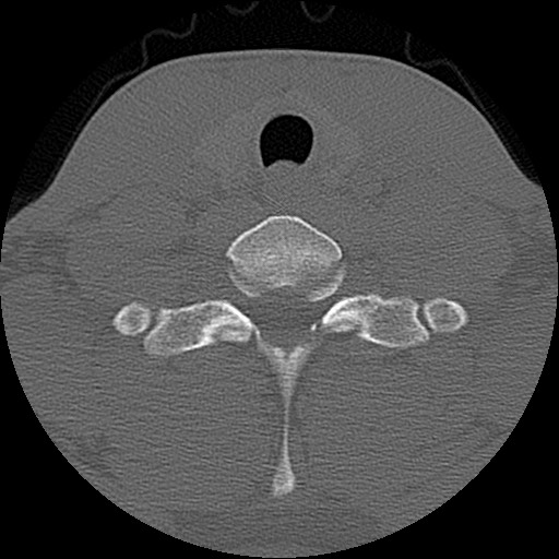 File:C5 facet fracture (Radiopaedia 58374-65499 Axial bone window 76).jpg