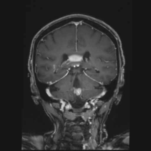 File:CNS lymphoma with steroid response (Radiopaedia 37980-39921 Coronal T1 C+ 30).png
