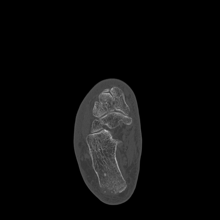 Calcaneal tuberosity avulsion fracture (Radiopaedia 22649-22668 Axial bone window 27).jpg