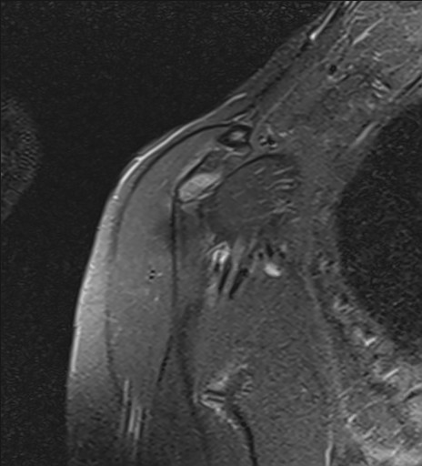 File:Calcific tendinitis of the infraspinatus tendon (Radiopaedia 87256-103537 Coronal PD fat sat 5).jpg