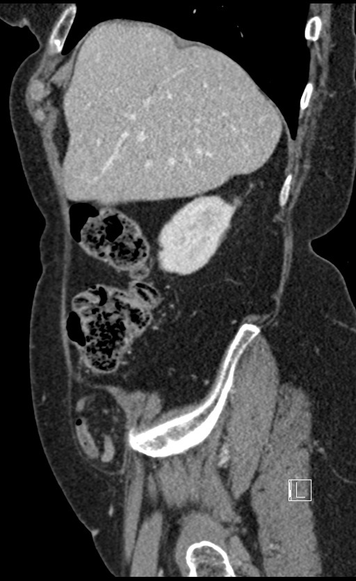 Calcified adrenal glands and Spigelian hernia (Radiopaedia 49741-54988 C 130).jpg