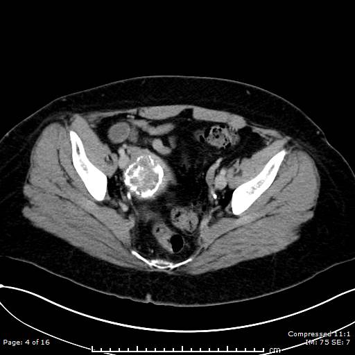 File:Calcified uterine fibroid (Radiopaedia 56077-62759 Axial C+ delayed 4).jpg