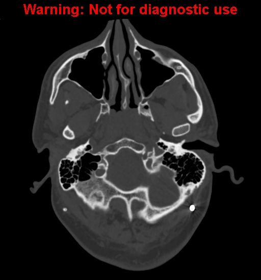 File:Calvarial thickening from chronic shunting (Radiopaedia 60079-67637 Axial bone window 20).jpg