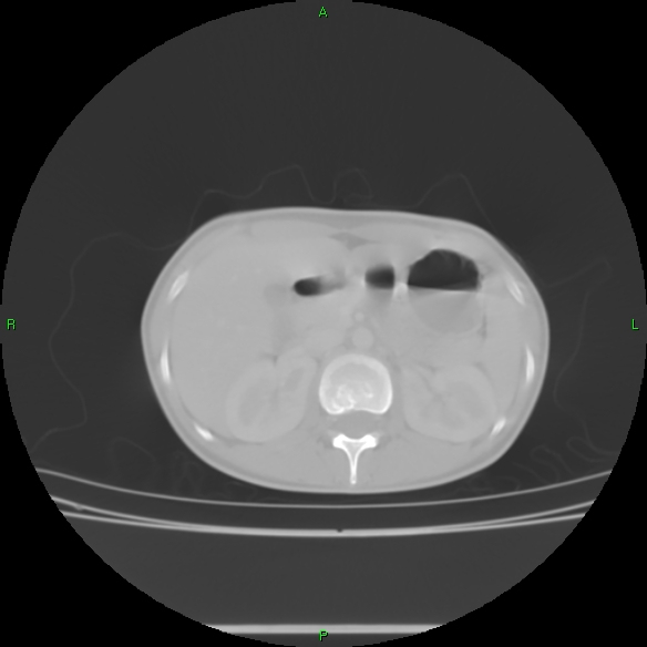 File:Cannon ball metastases - synovial sarcoma (Radiopaedia 26135-26271 Axial lung window 41).jpg