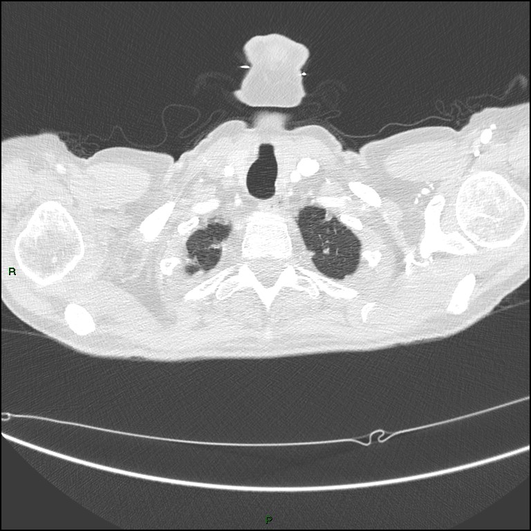 Cannonball metastases (Radiopaedia 82110-96150 Axial lung window 22).jpg