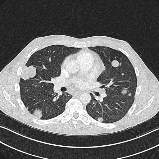Cannonball metastases - testicular choriocarcinoma (Radiopaedia 84510-99891 Axial lung window 50).jpg