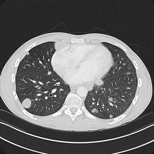 Cannonball metastases - testicular choriocarcinoma (Radiopaedia 84510-99891 Axial lung window 65).jpg
