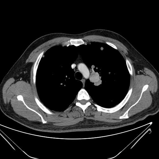 File:Cannonball pulmonary metastases (Radiopaedia 67684-77101 D 85).jpg