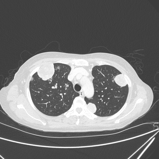Canonball lung metastasis (Radiopaedia 77634-89837 Axial lung window 48).jpg