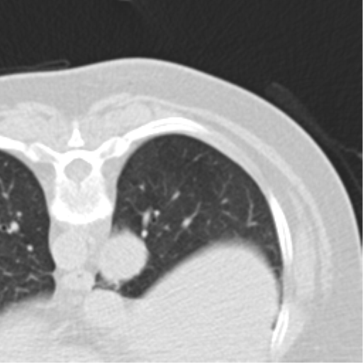 Carcinoid tumor - lung (Radiopaedia 44814-48644 Axial lung window 39).png