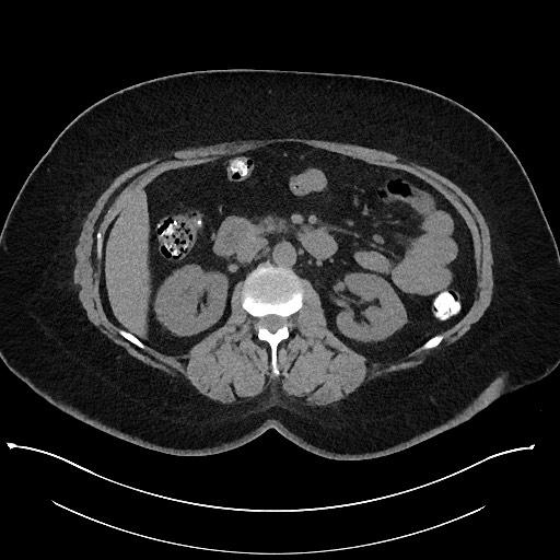 Carcinoid tumor - terminal ileum (Radiopaedia 60931-68740 Axial non-contrast 44).jpg