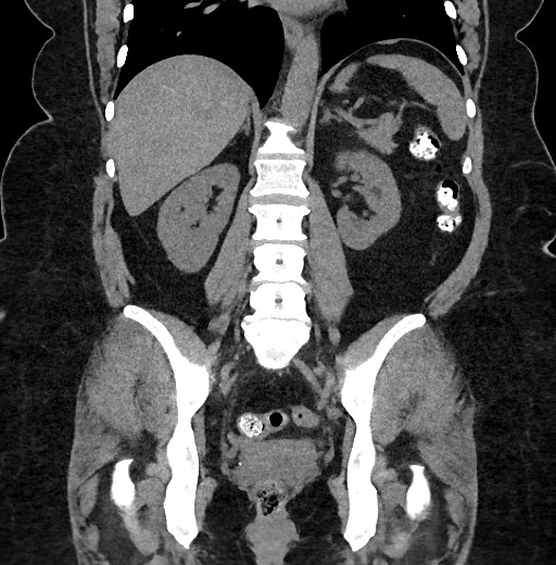 Carcinoid tumor - terminal ileum (Radiopaedia 60931-68740 Coronal non-contrast 70).jpg