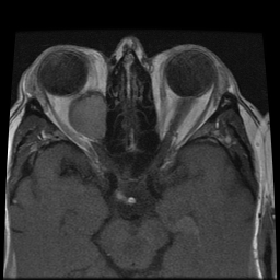 File:Carcinoid tumor of the ileum with metastasis to orbit (Radiopaedia 28165-28424 Axial T1 13).jpg