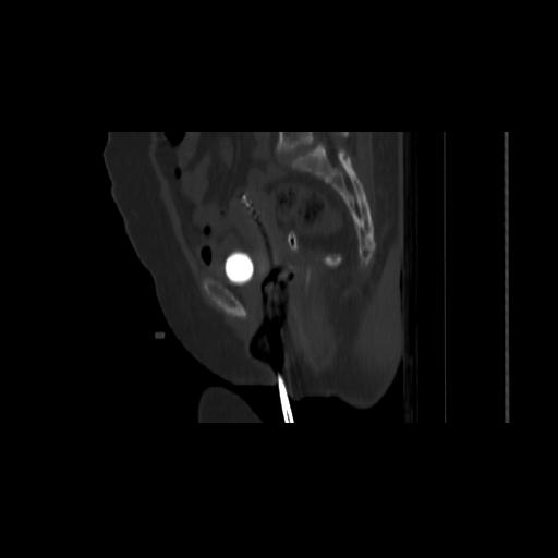 Carcinoma cervix- brachytherapy applicator (Radiopaedia 33135-34173 Sagittal bone window 82).jpg