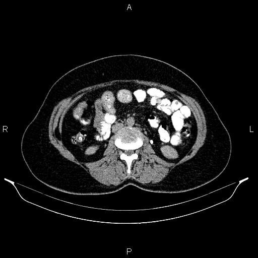File:Carcinoma of uterine cervix (Radiopaedia 85861-101700 Axial C+ delayed 36).jpg