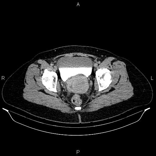 File:Carcinoma of uterine cervix (Radiopaedia 85861-101700 Axial C+ delayed 83).jpg