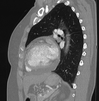 File:Cardiac sarcoidosis (Radiopaedia 74548-85534 Sagittal lung window 34).jpg