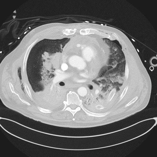 Cardiac trauma (Radiopaedia 32874-33858 Axial lung window 28).jpg