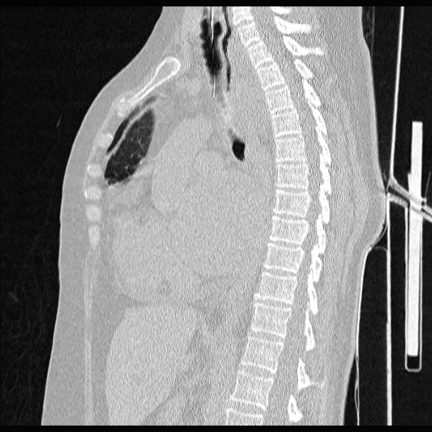 Cardiogenic pulmonary edema (Radiopaedia 29213-29609 Sagittal lung window 50).jpg
