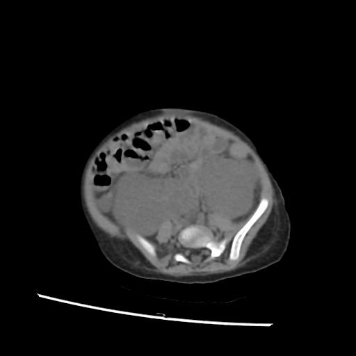 File:Caroli disease with autosomal recessive polycystic kidney disease (ARPKD) (Radiopaedia 89651-106703 Axial non-contrast 43).jpg