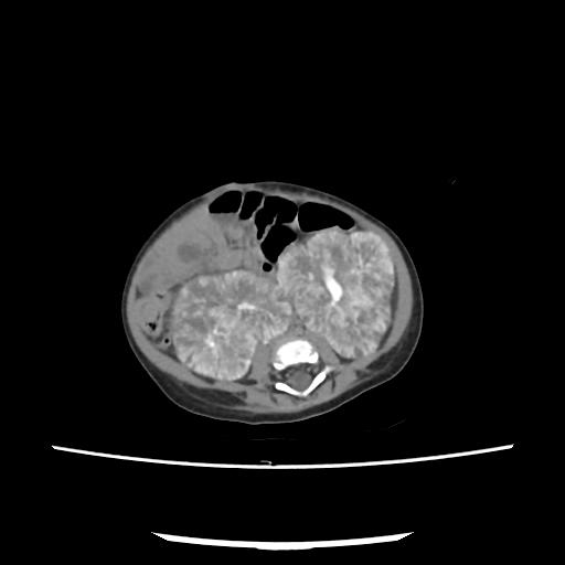 Caroli disease with autosomal recessive polycystic kidney disease (ARPKD) (Radiopaedia 89651-106703 E 152).jpg