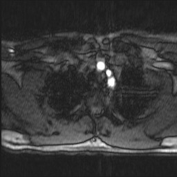 Carotid artery dissection (Radiopaedia 28441-28689 Axial MRA 1).jpg