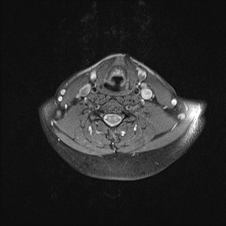 File:Carotid artery dissection (Radiopaedia 28441-28689 Axial T1 fat sat 17).jpg