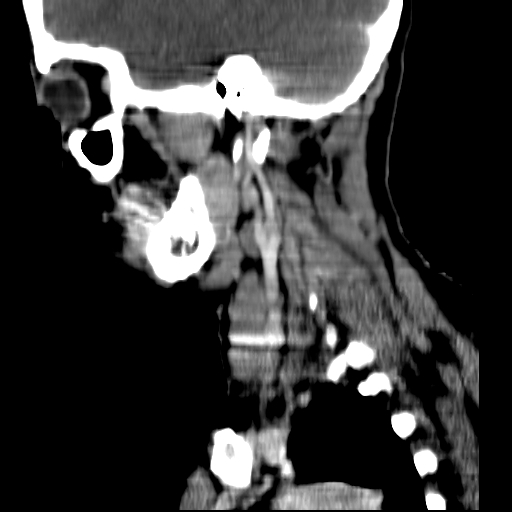 File:Carotid body tumor (Radiopaedia 27890-28124 C 4).jpg