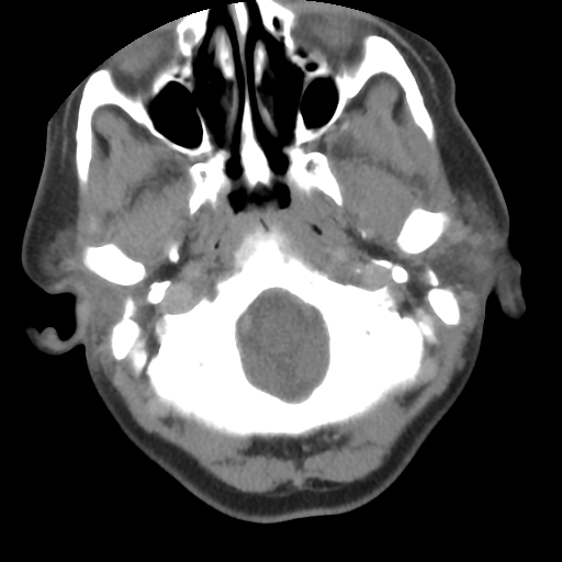 Carotid body tumor (paraganglioma) (Radiopaedia 38586-40729 A 42).jpg