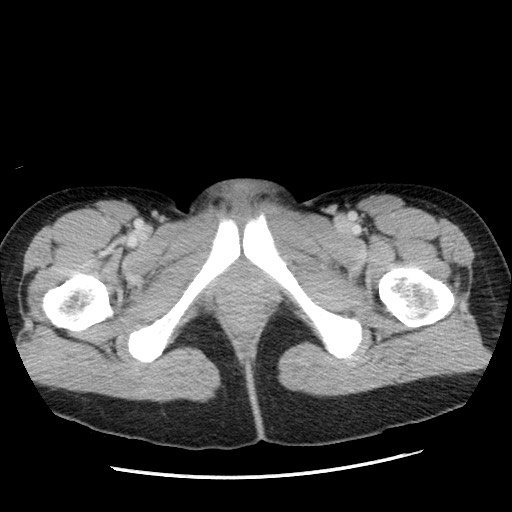Castleman disease with fibrous pseudotumor in the abdomen (Radiopaedia 77296-89373 A 136).jpg