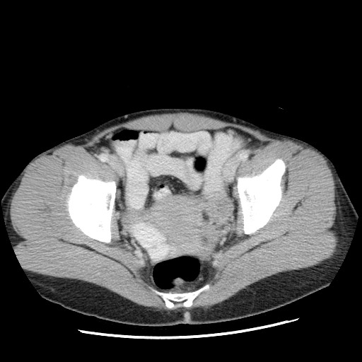File:Castleman disease with fibrous pseudotumor in the abdomen (Radiopaedia 77296-89373 Axial 80).jpg